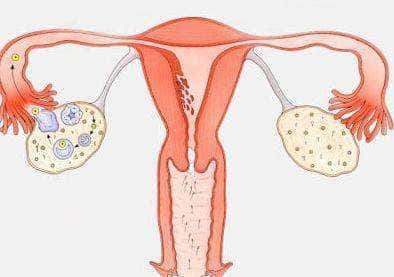 卵巢过度刺激综合症为体外受孕辅助生育的主要并发症之一