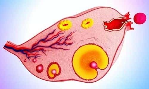 多囊卵巢试管婴儿注意事项有哪些?