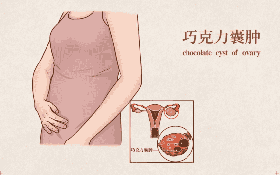女性患有巧克力囊肿，不仅影响卵巢功能