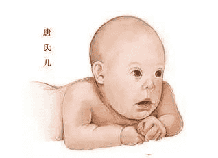 唐氏综合征-泰国试管婴儿帕雅泰3医院